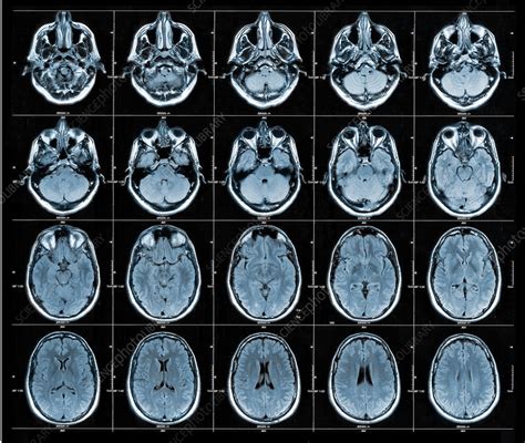 Axial Brain Mri Stock Image C Science Photo Library