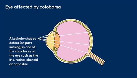 Coloboma Of The Eye