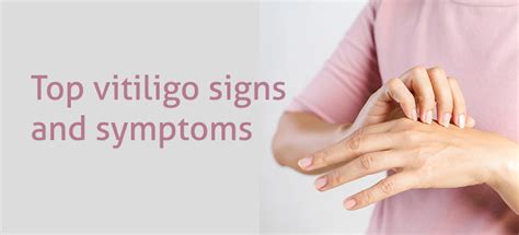 Top vitiligo signs and symptoms