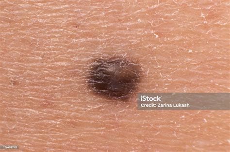 Mole Birthmark Nevus Macro Photo On Human Skin Close Up Stock Photo