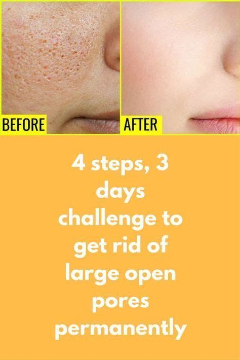 Steps Days Challenge To Get Rid Of Large Open Pores Permanently If