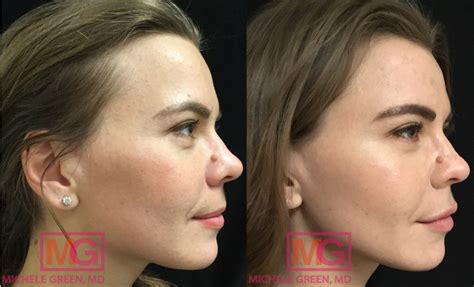 Fraxel Acne Scars Before And After