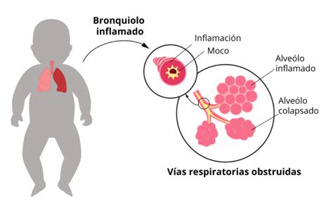 Bronquiolitis S Ntomas Causas Y Tratamiento Pediatra Sevilla