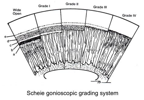 Gonioscopy III Flashcards Quizlet