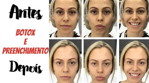 Voce Sabe A Diferenca Entre Botox E Preenchimento Youtube Otosection