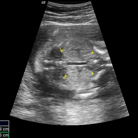 Ultrasound Identification Of Morphological Features In Trisomy 13 Patau S Syndrome Fetuses