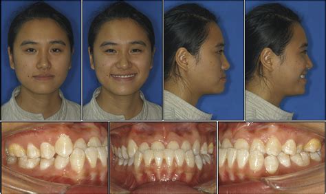 Figure 1 From Nonsurgical Correction Of A Class Iii Malocclusion In An Adult By Miniscrew