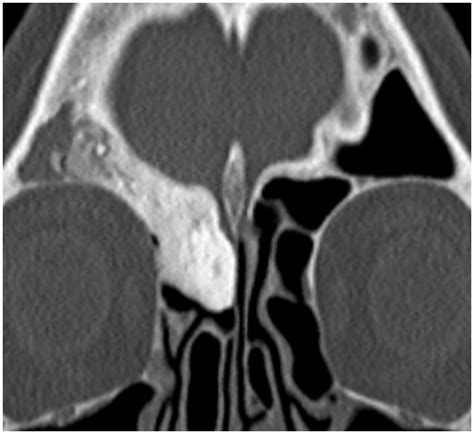 Imaging Review Of The Anterior Skull Base Olivia Francies Levan