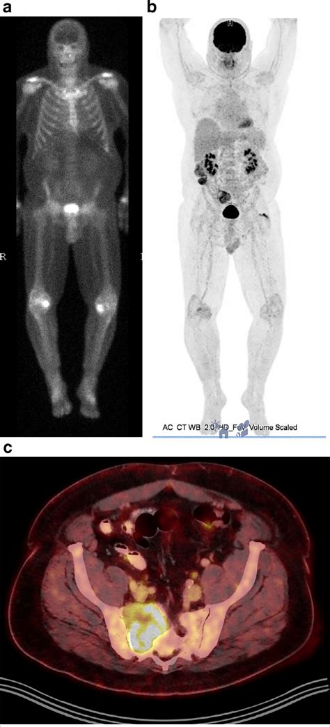 A Whole Body Bone Scintigraphy Showing No Suspicious Radiotracer