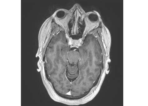 Figure Axial FSPGR Sequence With Contrast StatPearls NCBI