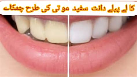 Natural Way To Whiten Your Teeth Home Remedy Amnanoor Youtube