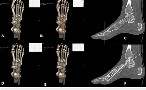 Three Dimensional Reconstructed CT Images Panes A B D And E And