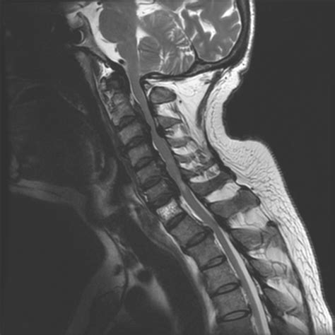 Ossification Of Posterior Longitudinal Ligament Image