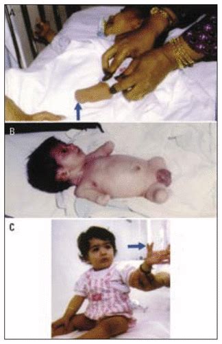 A Morpho Etiological Description Of Congenital Limb Anomalies Annals Of Saudi Medicine