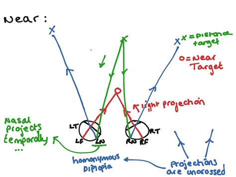 Homonymous Physiological Diplopia Music Showme