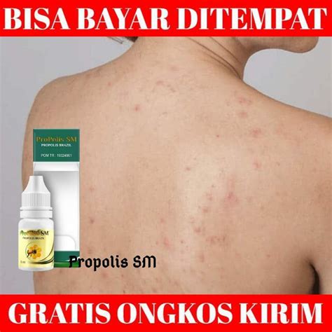 Obat Infeksi Jamur Kulit Penyakit Kulit Dermatitis Numularis Kurap