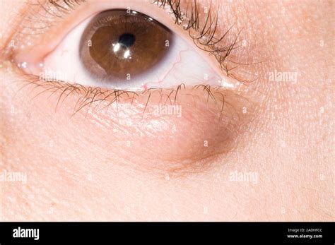 Chalazion Cyst On An Eyelid A Chalazion Or Meibomian Cyst Is Caused