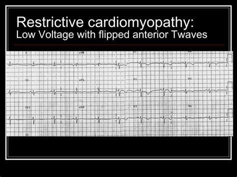 Ppt Top Ten Or 11 Ekg Killers Powerpoint Presentation Free