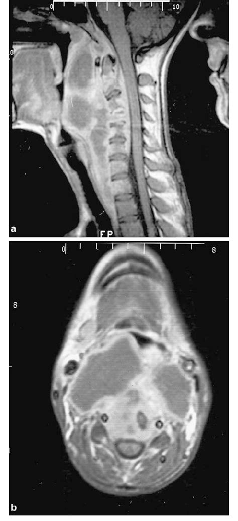 Cervical Sagittal A And Axial B Mri Sections The Axial Section Was