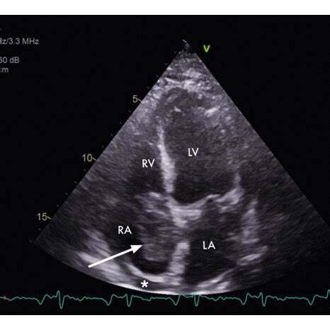 Transthoracic Echocardiogram Apical Four Chamber View Demonstrating A