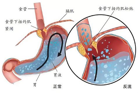 反流性食管炎模型 【动物造模】反流性食管炎十二指肠食管韧带细胞炎症 健康界