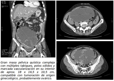 El Blog de Isa y Juan Cáncer de ovario y carcinomatosis peritoneal