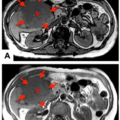 Preoperative Magnetic Resonance Imaging T1 A And T2 B Axial Phase Download Scientific