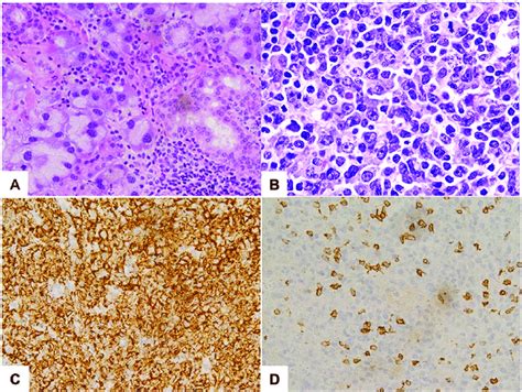 Lymphocytic Infiltrates Into Parenchymal Organs And B Cell Malignancies Download Scientific