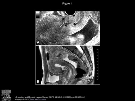 A Case Of Secondary Amenorrhea Caused By Uterine Myoma Successfully