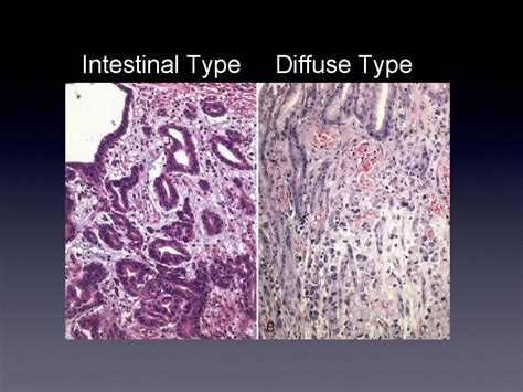 Intestinal Metaplasia of the Stomach A Review Kent