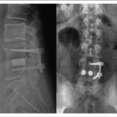 One Year Postposterior Lumbar Interbody Fusion Plif Using Porous