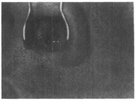 Figure From Nasal Septal Ulceration And Perforation In Jiggers