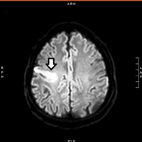 Initial brain MRI with gadolinium showing an acute infarct measuring 4... | Download Scientific ...