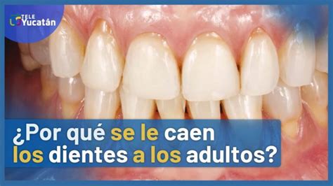 A qué Edad se Caen los Dientes en Adultos Todo lo que Debes Saber