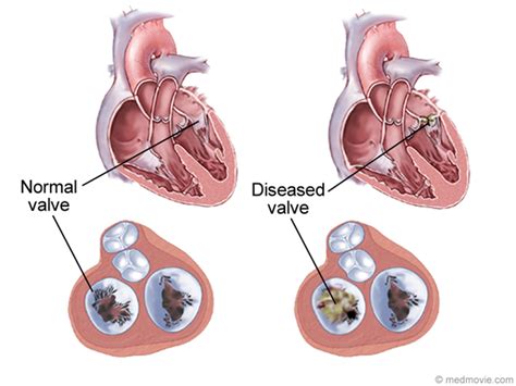 Diseases Heart Valve Disease