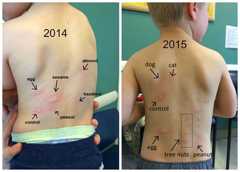 A New Nill: Allergy update 2015