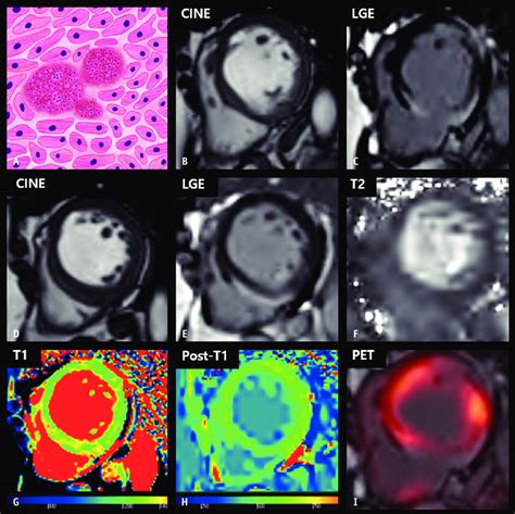 Cmr Findings Of Cardiac Sarcoidosis Based On Histologic Features A A