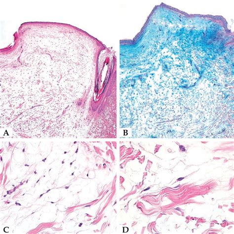 Scielo Brasil Clinical Dermoscopic And Histologic Aspects Of Two