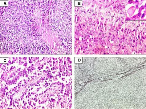 Proximal Type Epithelioid Sarcoma Of Perineum 2a Tumor Cells Showing Download Scientific