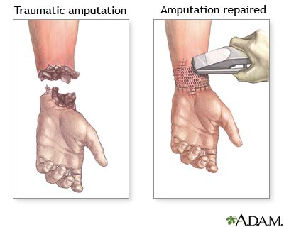 Traumatic Amputation Lima Memorial Health System