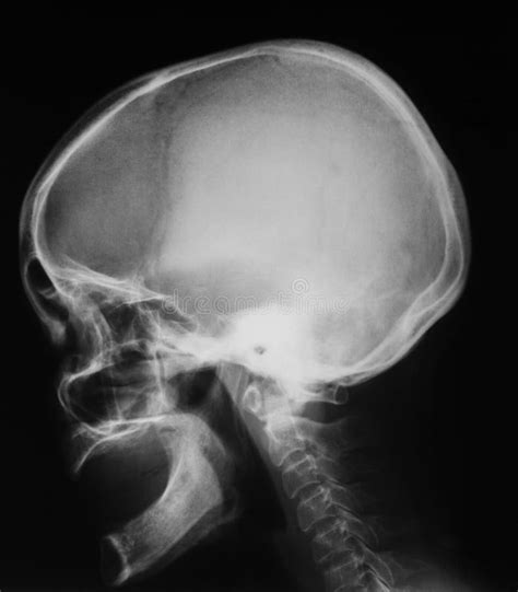 X Ray Image Of Skull Lateral View Stock Image Image Of Radiation