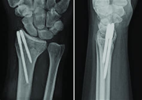 Postoperative X Ray Anteroposterior And Lateral Views Of The Same