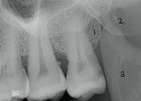 Intraoral Imaging Anatomy Flashcards Quizlet