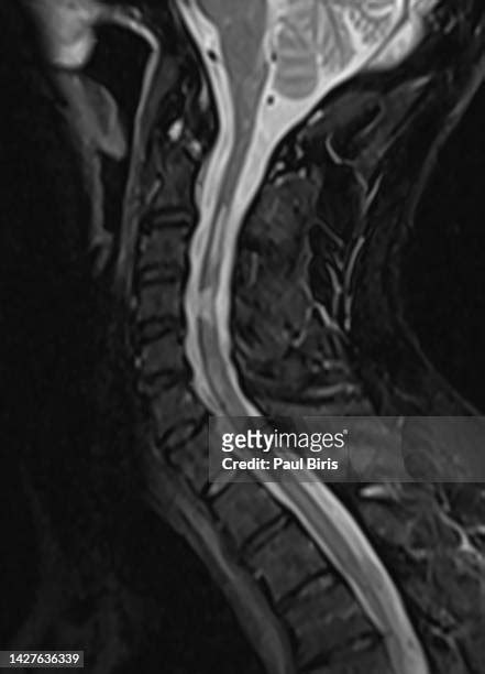 Mri Cervical Spine Stockfotos En Beelden Getty Images