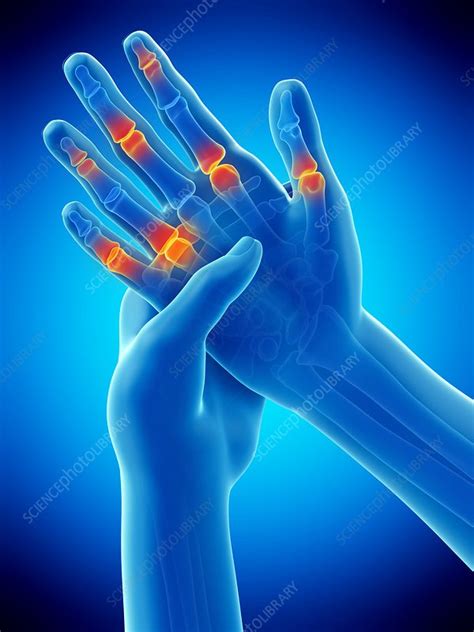 Finger Pain Conceptual Illustration Stock Image F025 8002