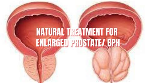 Natural Treatment For Enlarged Prostate BPH Benign Prostatic