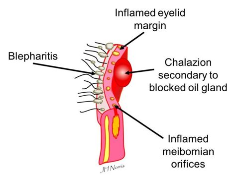 Chalazion Eyelid Cysts Jonathan Norris