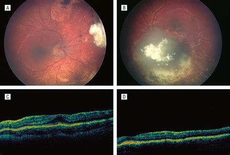 Restoration Of Foveal Anatomy And Function Following Chemoreduction For Bilateral Advanced