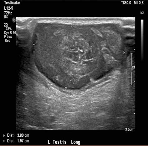 Longitudinal Ultrasound Image Showing The Heterogenous Left Testis