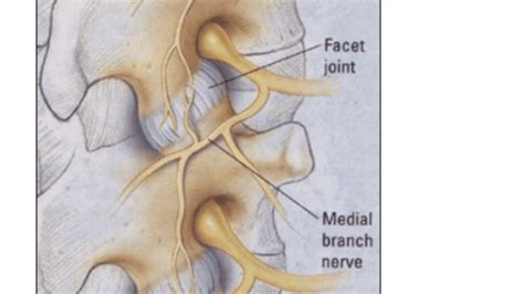 Medial Branch Blocks Tarpon Interventional Pain Spine Care